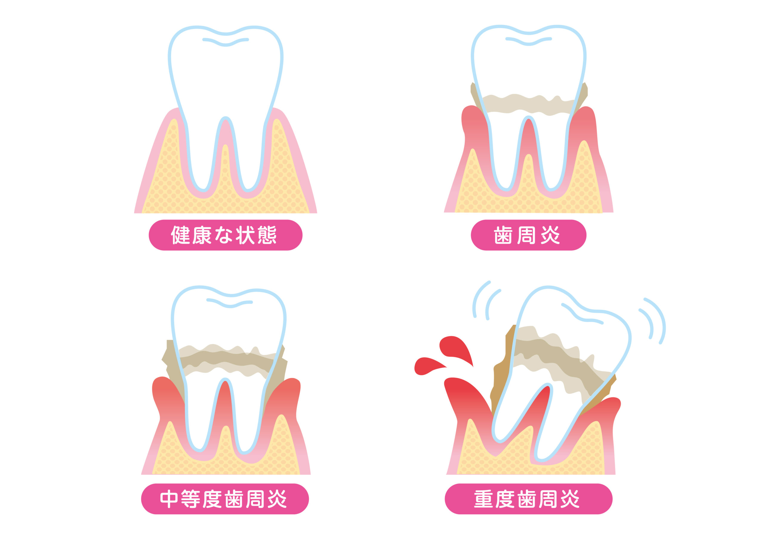歯周病治療について